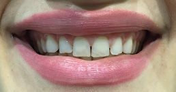 Cosmetic dentistry before and after