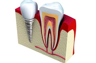 risks of dental implants
