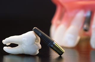 immediate loading of dental implants