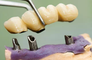 dental bridge prices