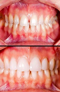 veneers before and after