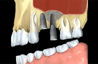 bone grafting dental