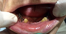 dental-implants-reviews