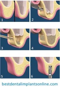 Bone graft for dental implant