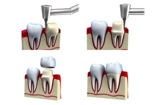 Dental crowns