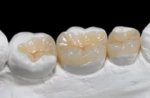 Dental inlay -BestDentalimplants