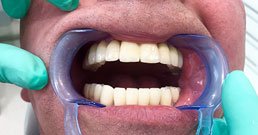 Dental implant recommendations Dental implant recommendations