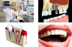 about dental implants