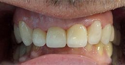 Dental crowns before and after dental crowns before after