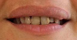 Dental crowns before and after