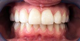 4 veneers on front teeth before and after