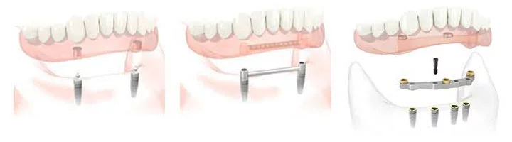 implant supported dentures