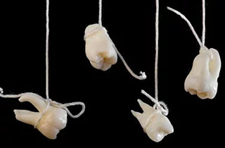 wisdom tooth removalcosts