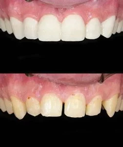 getting-teeth-fixed