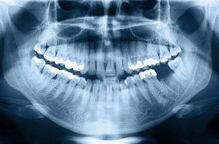 bone loss in the jaw