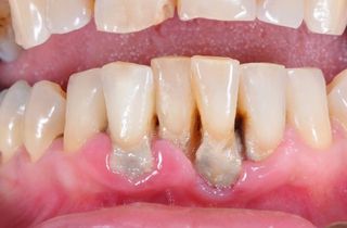 Periodontitis